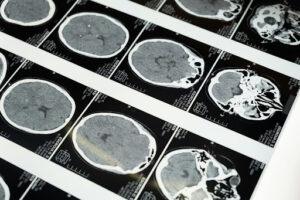 Close-up of multiple brain CT scan images laid out in rows, showing different cross-sections of the human brain in grayscale.